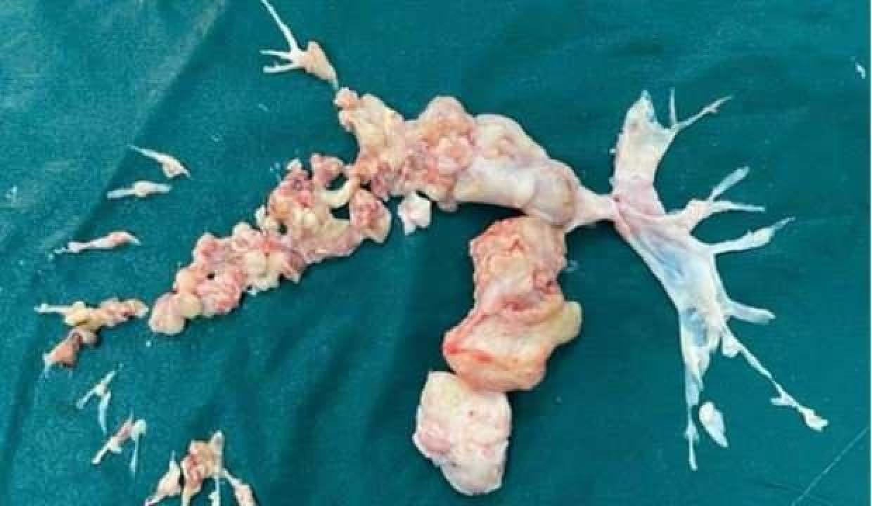 Kovid'e bağlı pıhtı sanıldı, ameliyatta ortaya çıkan gerçek doktorları bile şaşırttı